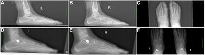 Efficacy of modified kidner procedure combined with subtalar arthroereisis treating adolescent type 2 painful accessory navicular with flexible flatfoot